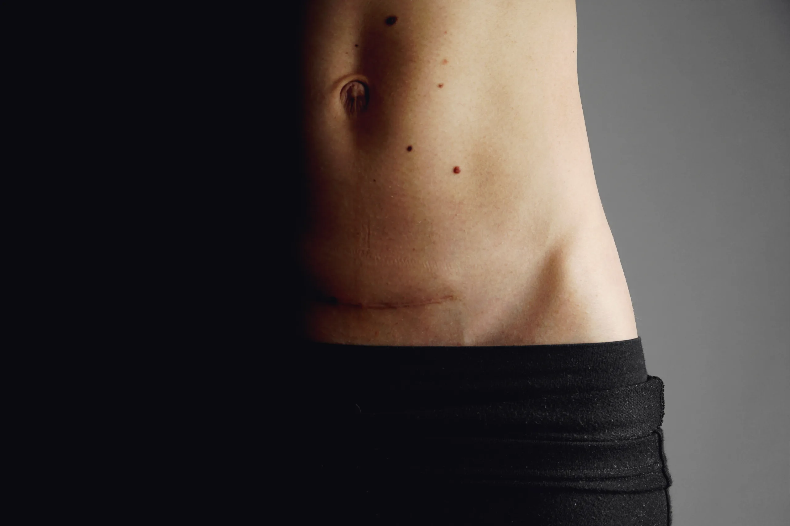 Closeup of woman belly with a scar from a cesarean section Kaiserschnitt